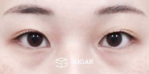 슈가성형외과 첫) 자연유착 전후사진 - 수술 전