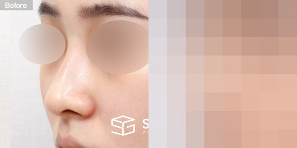 슈가성형외과 첫) 콧대 + 코끝 + 매부리코 + 휜코 전후사진 - 정면 수술 전후 비교