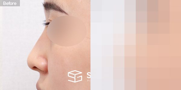 슈가성형외과 첫) 콧대 + 코끝 + 매부리코 + 휜코 전후사진 - 45도 수술 전후 비교