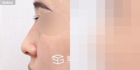 슈가성형외과 첫) 콧대 + 코끝 + 매부리코 + 휜코 전후사진 - 45도 수술 전후 비교