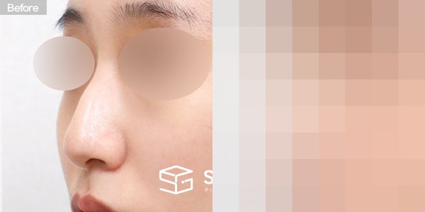 슈가성형외과 첫) 코끝 + 매부리코 + 휜코 전후사진 - 정면 수술 전후 비교