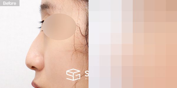 슈가성형외과 첫) 코끝 + 매부리코 + 휜코 전후사진 - 45도 수술 전후 비교