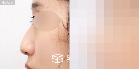 슈가성형외과 첫) 코끝 + 매부리코 + 휜코 전후사진 - 45도 수술 전후 비교