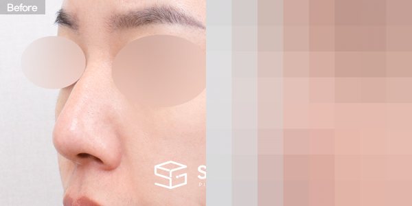 슈가성형외과 첫) 복코 + 매부리코 + 절골 전후사진 - 정면 수술 전후 비교