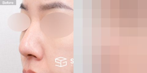 슈가성형외과 첫) 복코 + 매부리코 + 절골 전후사진 - 정면 수술 전후 비교