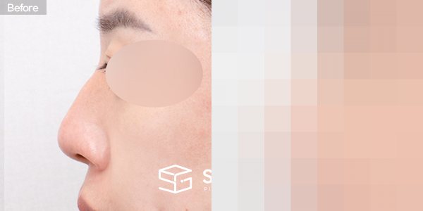 슈가성형외과 첫) 복코 + 매부리코 + 절골 전후사진 - 45도 수술 전후 비교
