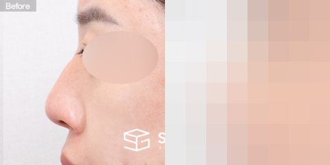 슈가성형외과 첫) 복코 + 매부리코 + 절골 전후사진 - 45도 수술 전후 비교