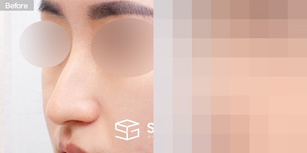 슈가성형외과 첫) 코끝 + 매부리코 + 휜코 전후사진 - 정면 수술 전후 비교