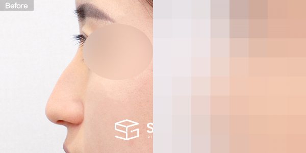 슈가성형외과 첫) 코끝 + 매부리코 + 휜코 전후사진 - 45도 수술 전후 비교
