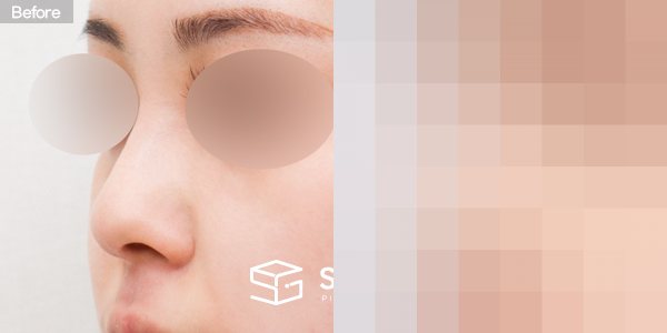 슈가성형외과 첫) 콧대 + 코긑 + 복코 + 절골 전후사진 - 정면 수술 전후 비교