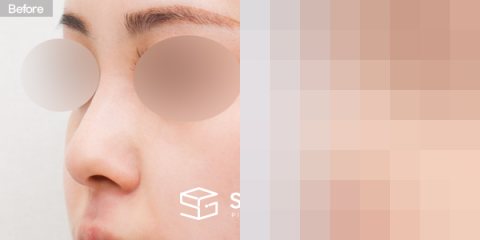 슈가성형외과 첫) 콧대 + 코긑 + 복코 + 절골 전후사진 - 정면 수술 전후 비교