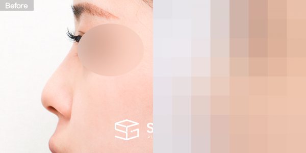 슈가성형외과 첫) 콧대 + 코긑 + 복코 + 절골 전후사진 - 45도 수술 전후 비교