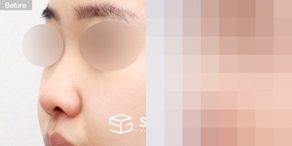 슈가성형외과 첫) 콧대 + 코끝 + 비중격 + 귀연골 전후사진 - 정면 수술 전후 비교