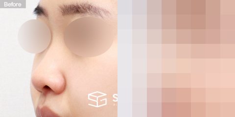 슈가성형외과 첫) 콧대 + 코끝 + 비중격 + 귀연골 전후사진 - 정면 수술 전후 비교