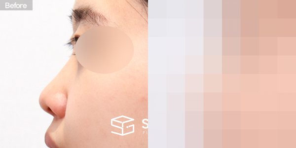 슈가성형외과 첫) 콧대 + 코끝 + 비중격 + 귀연골 전후사진 - 45도 수술 전후 비교