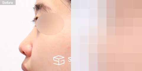 슈가성형외과 첫) 콧대 + 코끝 + 비중격 + 귀연골 전후사진 - 45도 수술 전후 비교