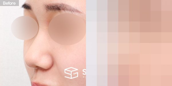 슈가성형외과 첫) 콧대 + 코끝 + 콧볼축소 + 비중격 연장 + 비주 지지 전후사진 - 정면 수술 전후 비교