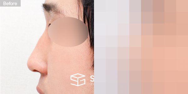 슈가성형외과 첫) 콧대 + 코끝 + 매부리코 + 절골 + 비주 지지 전후사진 - 45도 수술 전후 비교
