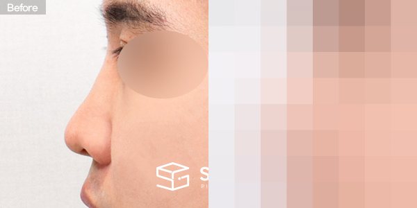 슈가성형외과 재) 재수술 + 절골 + 길이 연장 + 펼침 이식 전후사진 - 45도 수술 전후 비교