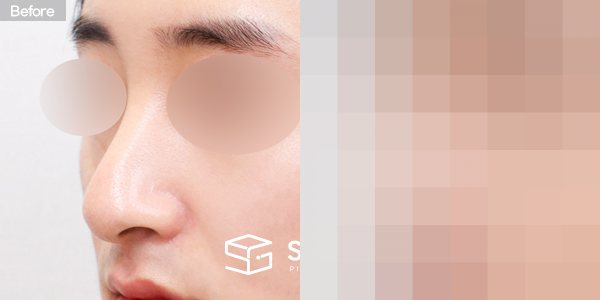 슈가성형외과 첫) 콧대 + 코끝 + 매부리코 + 휜코 + 절골 + 비중격 연장 전후사진 - 정면 수술 전후 비교