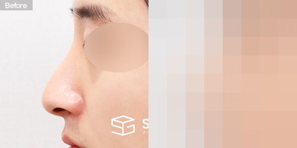 슈가성형외과 첫) 콧대 + 코끝 + 매부리코 + 휜코 + 절골 + 비중격 연장 전후사진 - 45도 수술 전후 비교