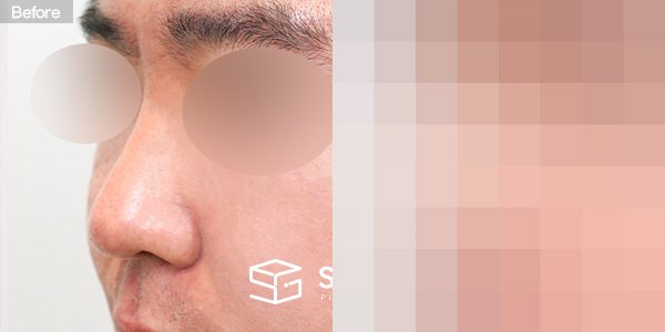 슈가성형외과 첫) 콧대 + 코끝 + 비중격 연장 + 비주 지지 전후사진 - 정면 수술 전후 비교