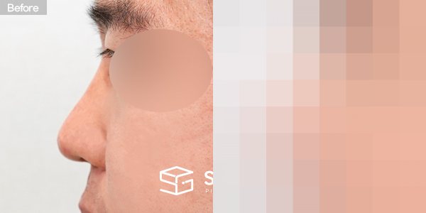 슈가성형외과 첫) 콧대 + 코끝 + 비중격 연장 + 비주 지지 전후사진 - 45도 수술 전후 비교