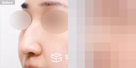 슈가성형외과 첫) 코끝 + 매부리코 + 비중격 + 귀연골 전후사진 - 정면 수술 전후 비교