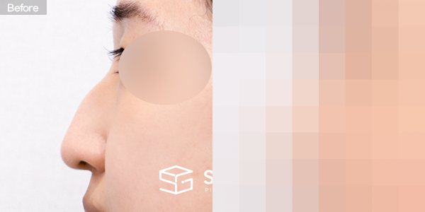슈가성형외과 첫) 코끝 + 매부리코 + 비중격 + 귀연골 전후사진 - 45도 수술 전후 비교