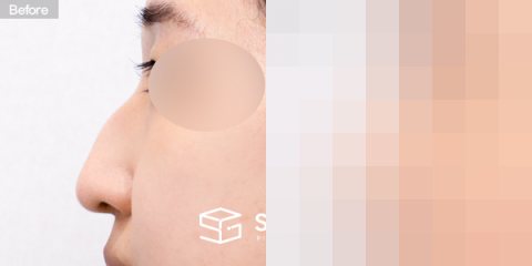 슈가성형외과 첫) 코끝 + 매부리코 + 비중격 + 귀연골 전후사진 - 45도 수술 전후 비교