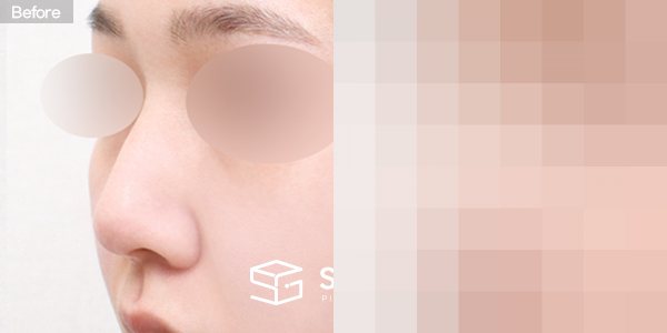 슈가성형외과 첫) 코끝 + 매부리코 + 절골 전후사진 - 정면 수술 전후 비교