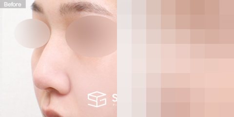 슈가성형외과 첫) 코끝 + 매부리코 + 절골 전후사진 - 정면 수술 전후 비교
