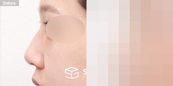 슈가성형외과 첫) 코끝 + 매부리코 + 절골 전후사진 - 45도 수술 전후 비교