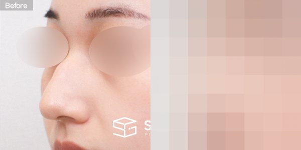 슈가성형외과 첫) 콧대 + 코끝 + 매부리코 + 휜코 + 절골 전후사진 - 정면 수술 전후 비교