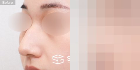 슈가성형외과 첫) 콧대 + 코끝 + 매부리코 + 휜코 + 절골 전후사진 - 정면 수술 전후 비교