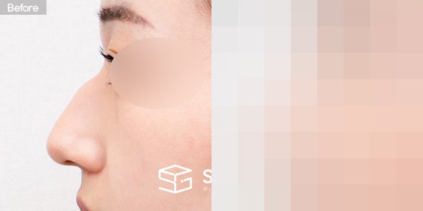 슈가성형외과 첫) 콧대 + 코끝 + 매부리코 + 휜코 + 절골 전후사진 - 45도 수술 전후 비교