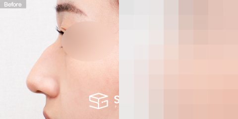 슈가성형외과 첫) 콧대 + 코끝 + 매부리코 + 휜코 + 절골 전후사진 - 45도 수술 전후 비교
