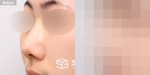 슈가성형외과 첫) 콧대 + 코끝 + 매부리코 전후사진 - 정면 수술 전후 비교