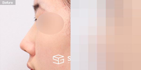 슈가성형외과 첫) 콧대 + 코끝 + 매부리코 전후사진 - 45도 수술 전후 비교