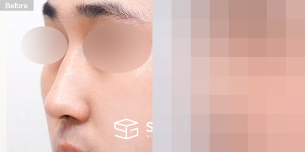 슈가성형외과 첫) 콧대 + 코끝 + 매부리코 + 절골 + 비주 지지 전후사진 - 정면 수술 전후 비교