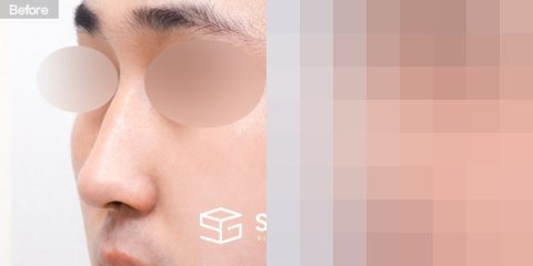 슈가성형외과 첫) 콧대 + 코끝 + 매부리코 + 절골 + 비주 지지 전후사진 - 정면 수술 전후 비교
