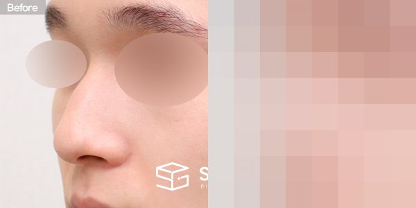 슈가성형외과 첫) 콧대 + 코끝 + 매부리코 + 긴코 + 절골 + 비중격 전후사진 - 정면 수술 전후 비교