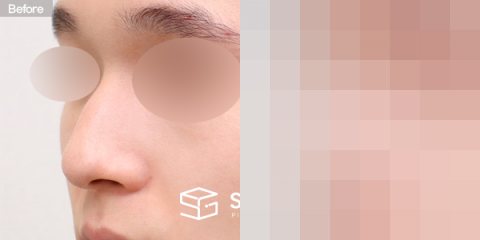 슈가성형외과 첫) 콧대 + 코끝 + 매부리코 + 긴코 + 절골 + 비중격 전후사진 - 정면 수술 전후 비교