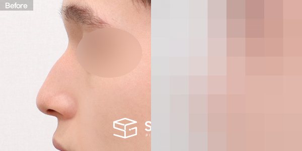 슈가성형외과 첫) 콧대 + 코끝 + 매부리코 + 긴코 + 절골 + 비중격 전후사진 - 45도 수술 전후 비교
