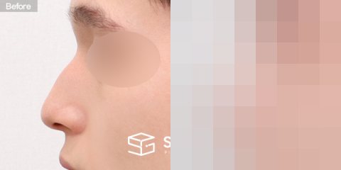 슈가성형외과 첫) 콧대 + 코끝 + 매부리코 + 긴코 + 절골 + 비중격 전후사진 - 45도 수술 전후 비교