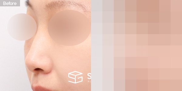 슈가성형외과 첫) 콧대 + 코끝 + 매부리코 + 무보형물 코성형 + 복코 + 절골 전후사진 - 정면 수술 전후 비교