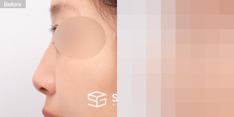 슈가성형외과 첫) 콧대 + 코끝 + 매부리코 + 무보형물 코성형 + 복코 + 절골 전후사진 - 45도 수술 전후 비교
