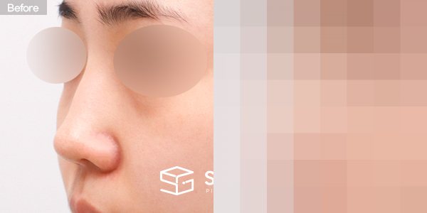 슈가성형외과 첫) 콧대 + 코끝 + 매부리코 + 절골 + 비주 내리기 + 귀연골 전후사진 - 정면 수술 전후 비교
