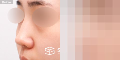 슈가성형외과 첫) 콧대 + 코끝 + 매부리코 + 절골 + 비주 내리기 + 귀연골 전후사진 - 정면 수술 전후 비교
