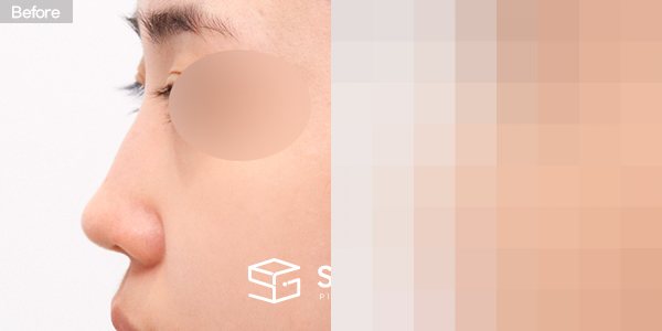 슈가성형외과 첫) 콧대 + 코끝 + 매부리코 + 절골 + 비주 내리기 + 귀연골 전후사진 - 45도 수술 전후 비교